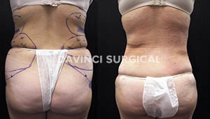 liposuction-20
