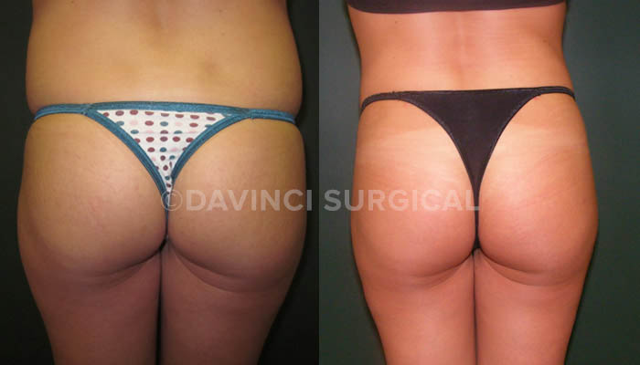 Brazilian Butt Augmentation Before and After Photo Gallery, Med Spa Orange  County