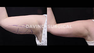 armlift-2