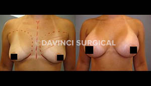 breast-augmentation-04