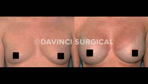 breast-augmentation-07