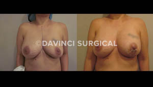 breast-augmentation-12