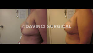 breast-augmentation-14