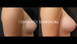 breast-augmentation-16