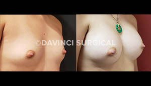 breast-augmentation-17