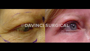 eyelid-lift-04