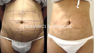 liposuction-15