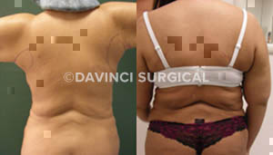 liposuction-18