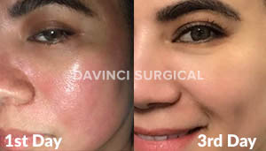 microneedling-01