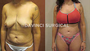 tummytuck