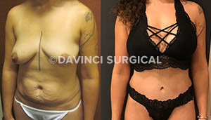 tummytuck