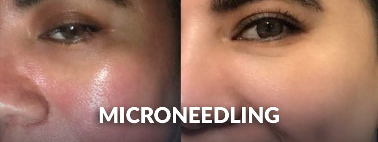 microneedling